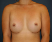 Feel Beautiful - Breast Augmentation 141 - After Photo